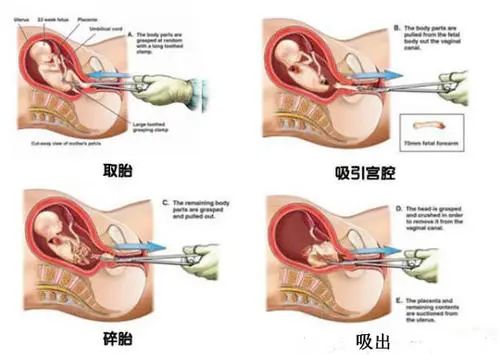 关于七个月引产的医疗知识与情感考量