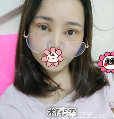 开眼角一个月，恢复、效果与体验